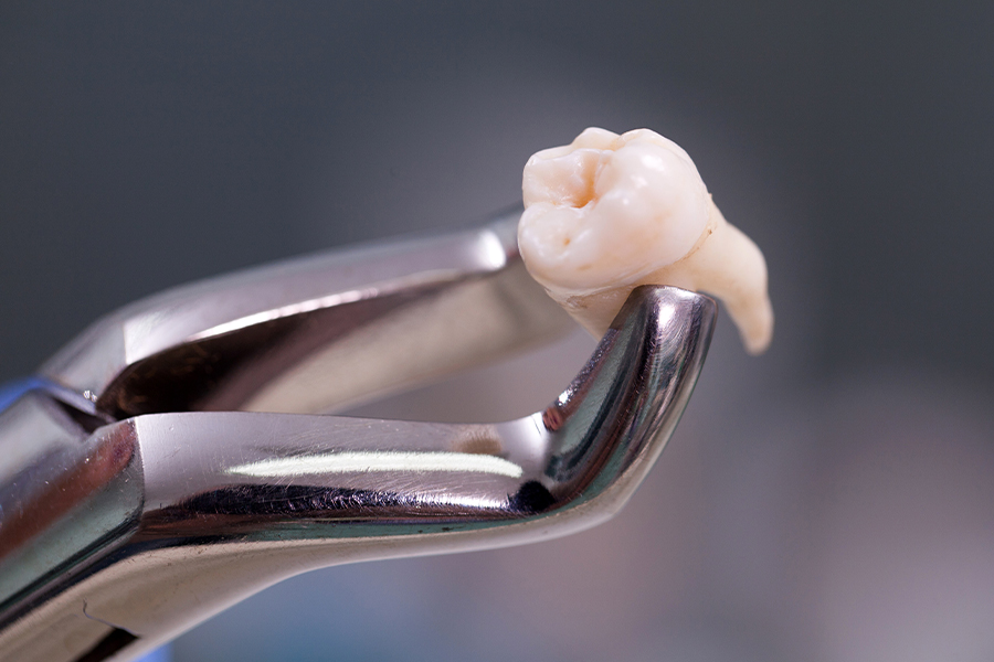 抜歯と非抜歯の基準について